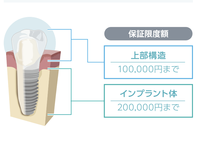 インプラント体